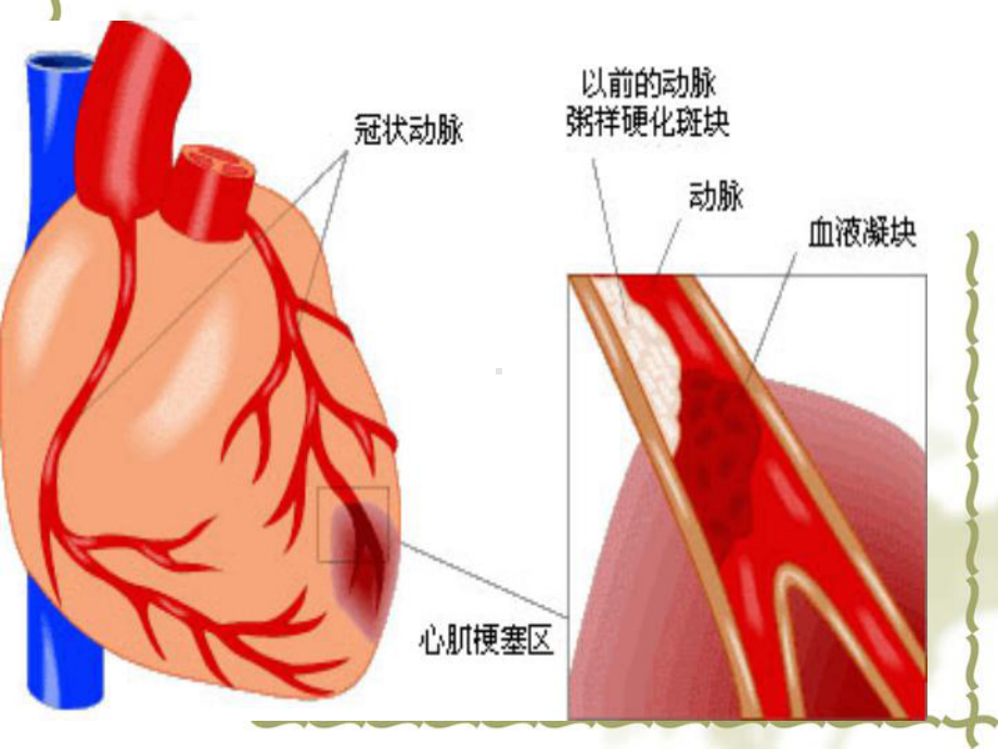 心梗的急救课件.ppt_第2页