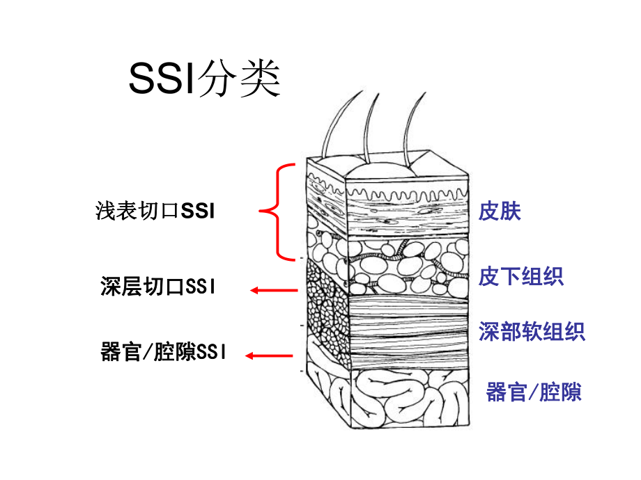 手术部位感染的控课件.ppt_第3页