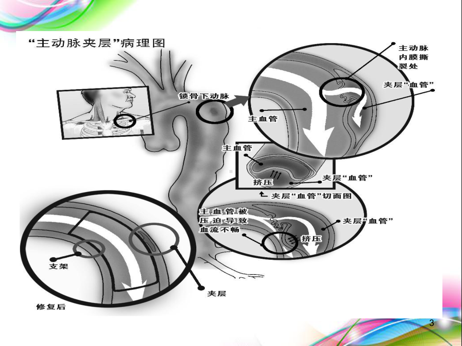 主动脉夹层护理查房医学课件.ppt_第3页