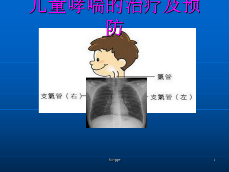 儿童哮喘的治疗及预防课件.ppt_第1页