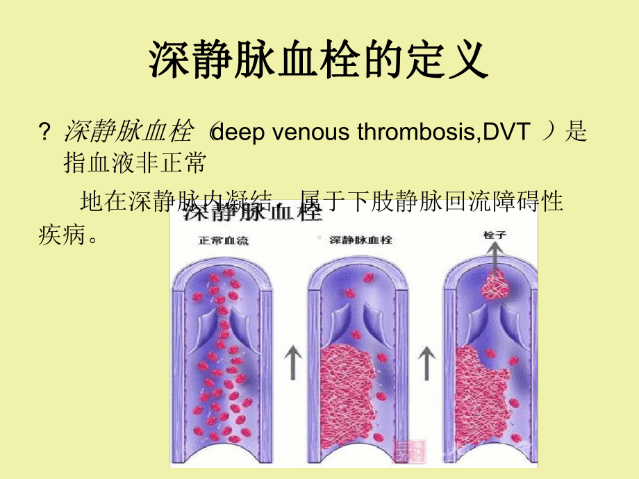 深静脉血栓评价课件.ppt_第2页