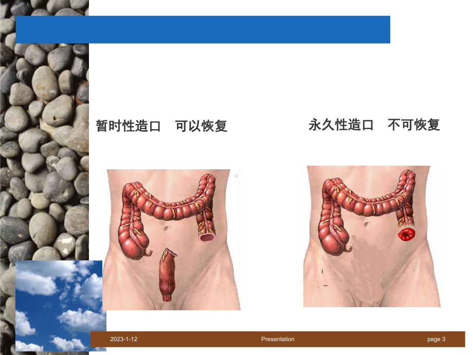 直肠癌的治疗及护理课件.ppt_第3页