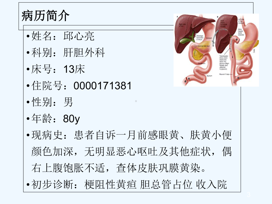 胆总管空肠吻合课件.ppt_第3页