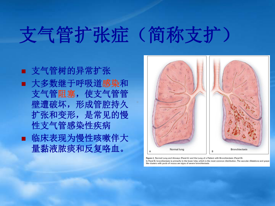 支气管扩张bronchiectasis课件.ppt_第2页