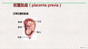 前置胎盘与胎盘植入影像表现课件完整版.ppt