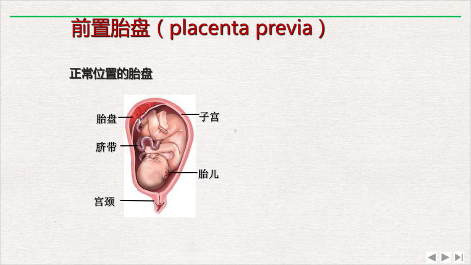 前置胎盘与胎盘植入影像表现课件完整版.ppt_第1页