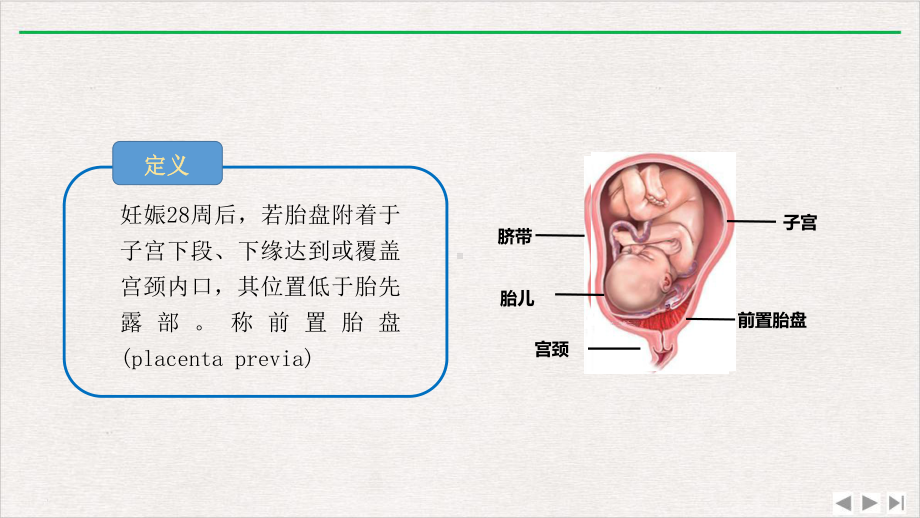 前置胎盘与胎盘植入影像表现课件完整版.ppt_第2页