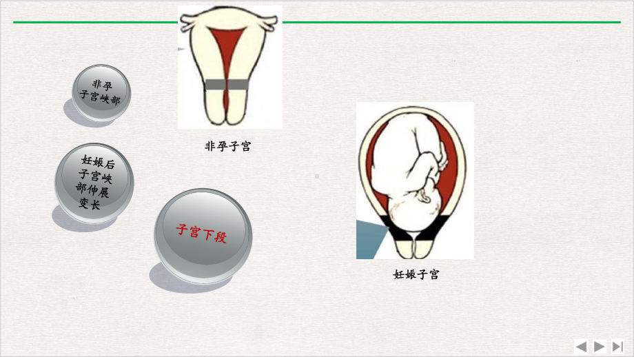 前置胎盘与胎盘植入影像表现课件完整版.ppt_第3页