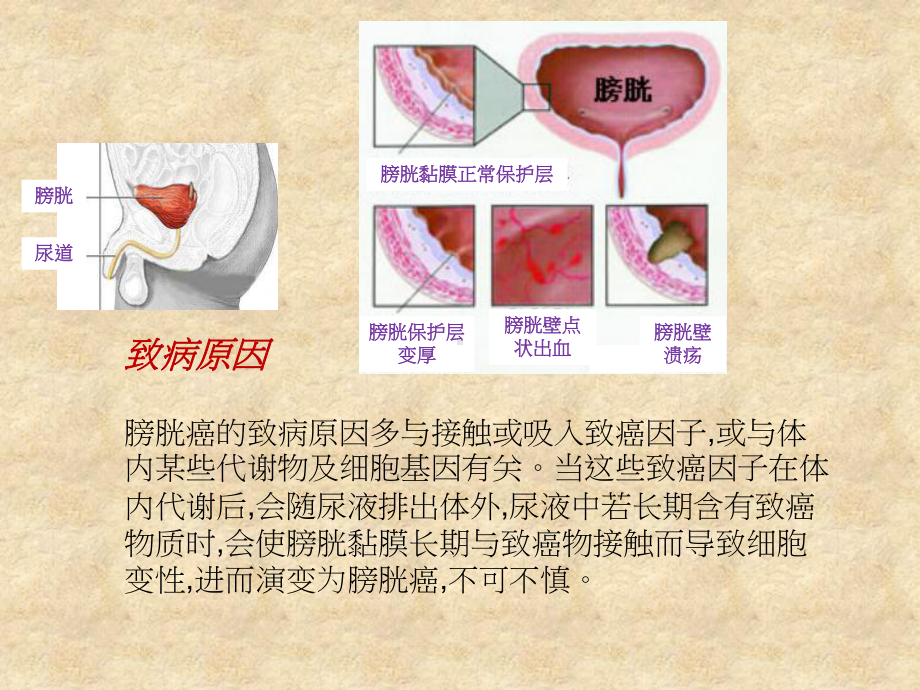 膀胱癌的症状PeacefulMind课件.ppt_第3页