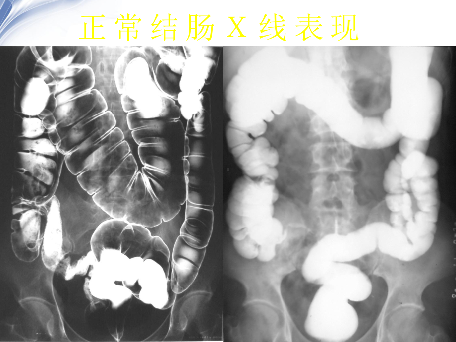 医学影像·结直肠肿瘤的影像诊断课件.ppt_第2页