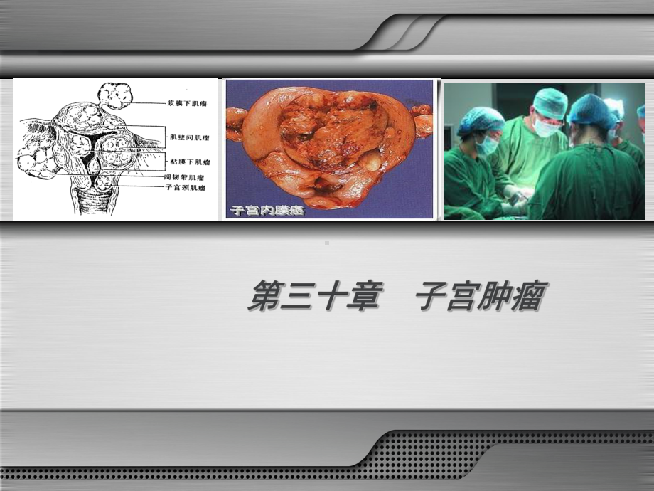 妇产科学第八版子宫肿瘤课件.ppt_第3页