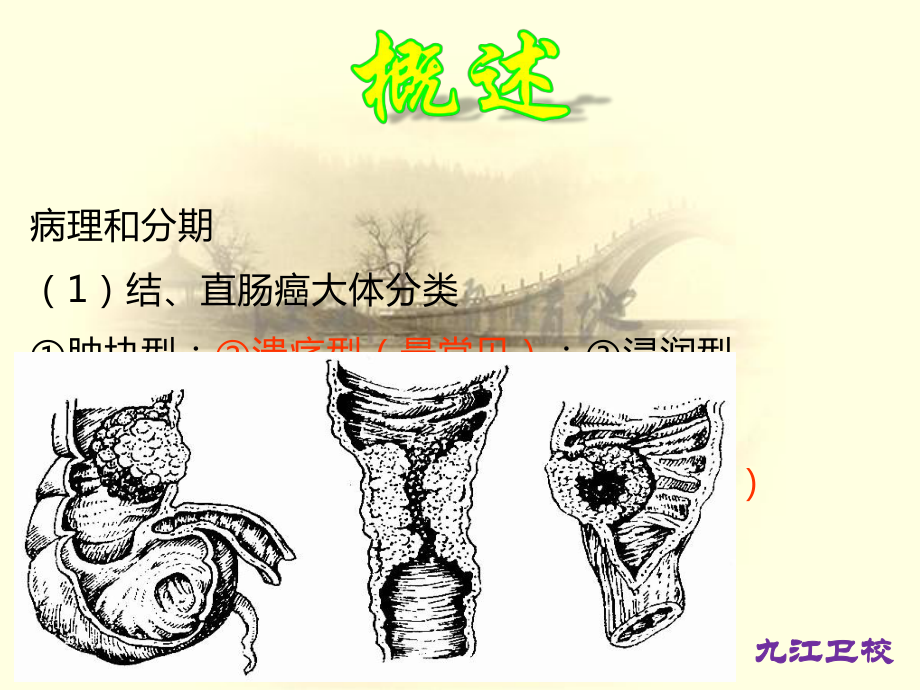 第13章第06节大肠癌病人的护理课件.pptx_第3页