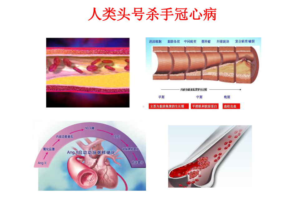 冠心病知识普及课件.ppt_第3页