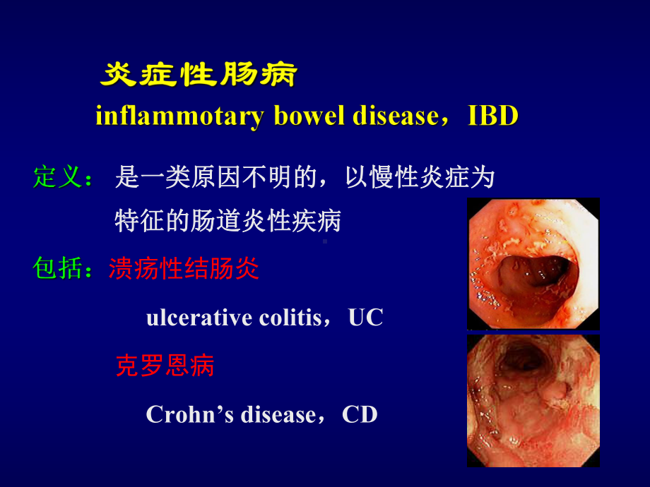 溃疡性结肠炎Ulcerativecolitis课件.ppt_第2页