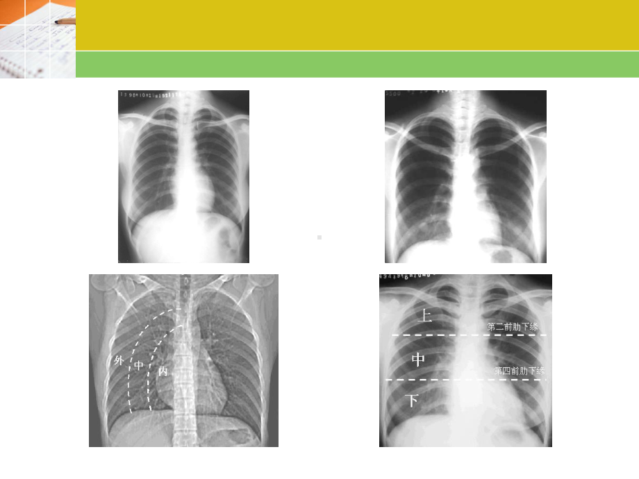 胸部X线阅片课件.ppt_第3页