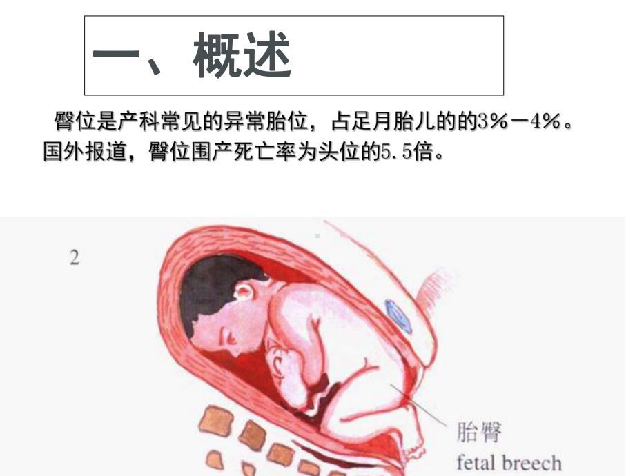 臀位分娩[1]（课件）.ppt_第2页