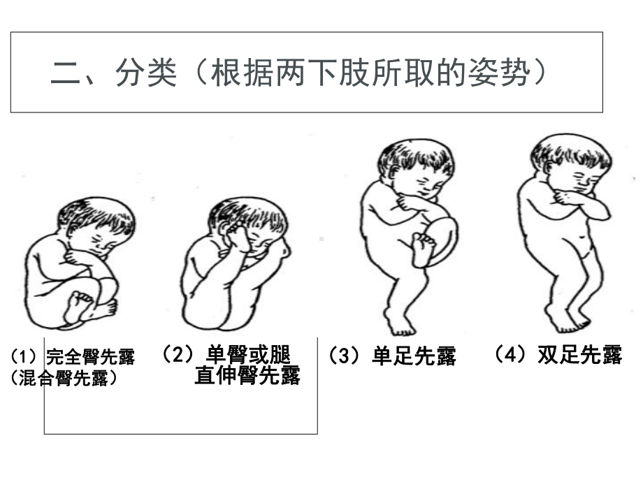 臀位分娩[1]（课件）.ppt_第3页