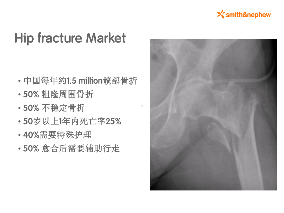 亚洲髋演示骨科手术器械课件.ppt_第2页