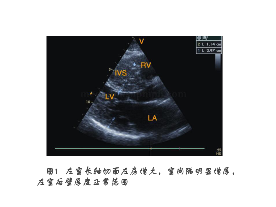 肥厚型心肌病课件.pptx_第3页