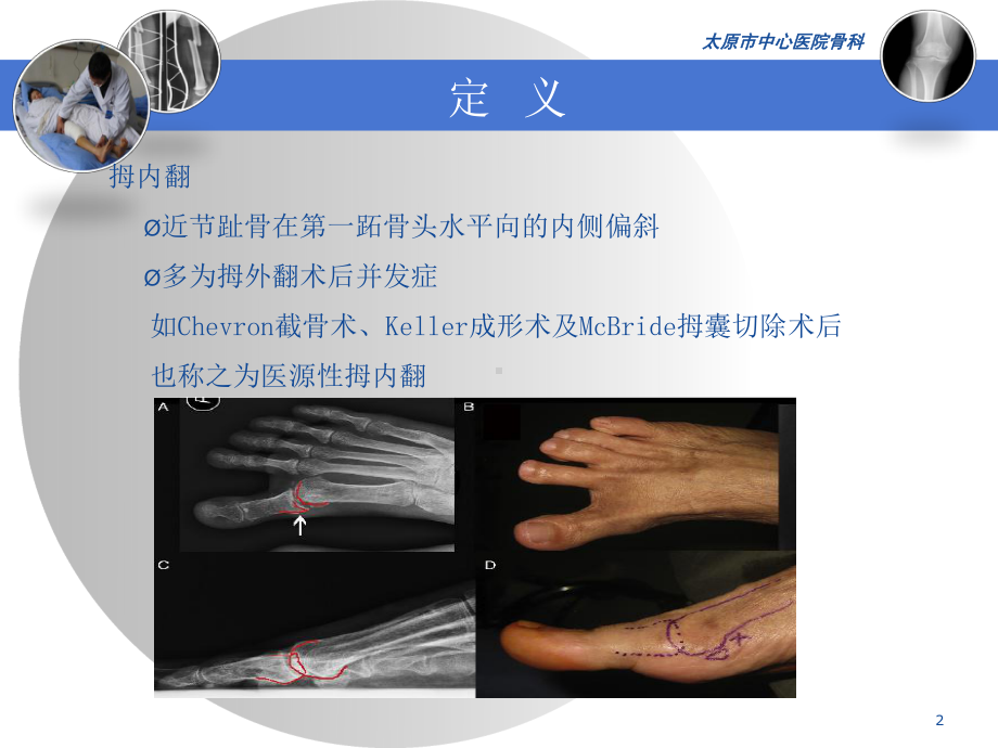 医源性拇内翻课件.ppt_第2页