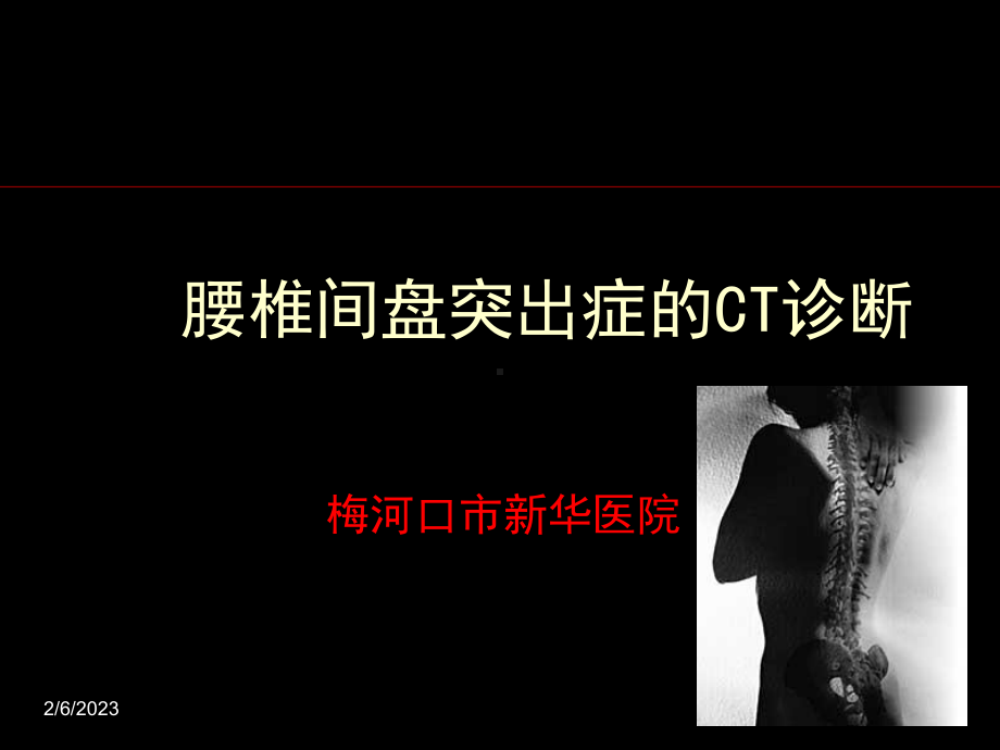 椎间盘突出症的CT表现课件.ppt_第1页