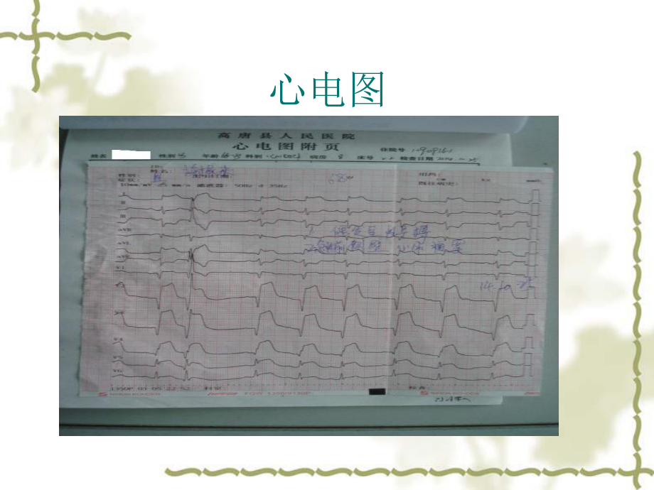 急诊冠状动脉介入术后替罗非班诱发极重度血小板减少症一例课件.ppt_第3页