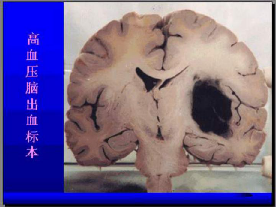 （临床医学）高血压脑出血治疗现状及进展课件.ppt_第2页