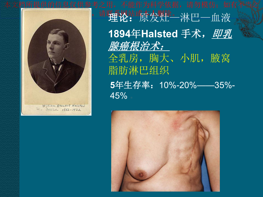 乳腺癌的手术治疗培训课件.ppt_第2页