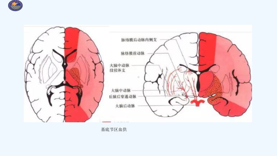 基底节病变袁振国课件.ppt_第3页