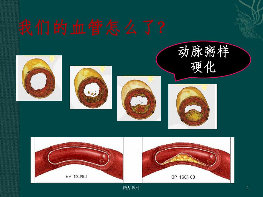 关注血脂关爱生命1课件.ppt_第2页