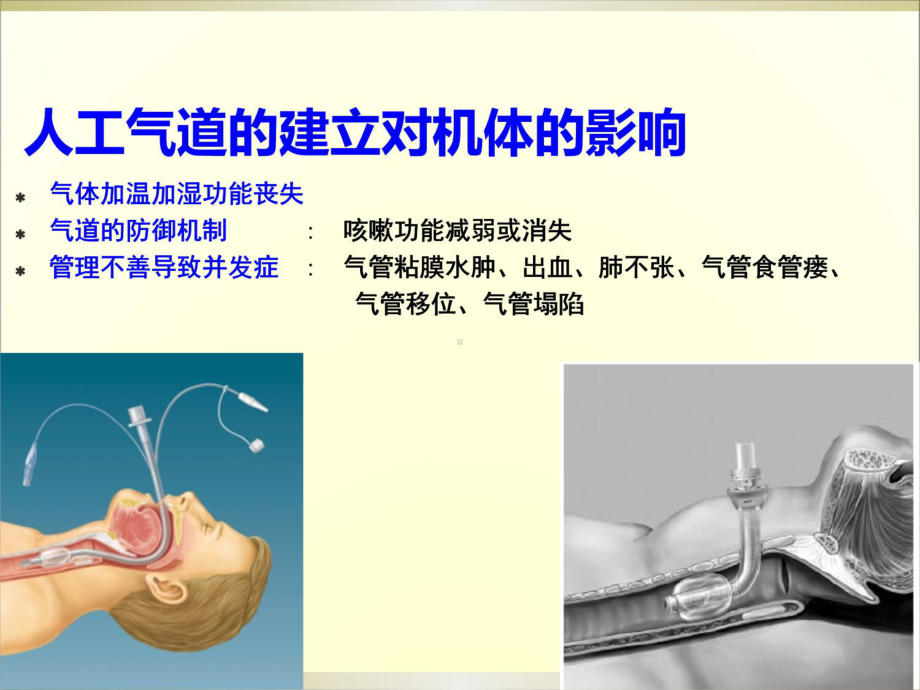 人工气道的管理备课讲稿课件.ppt_第3页