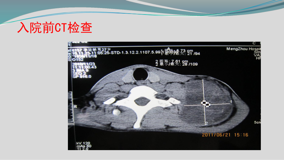 一例肩部软组织肉瘤的护理查房-课件.ppt_第3页