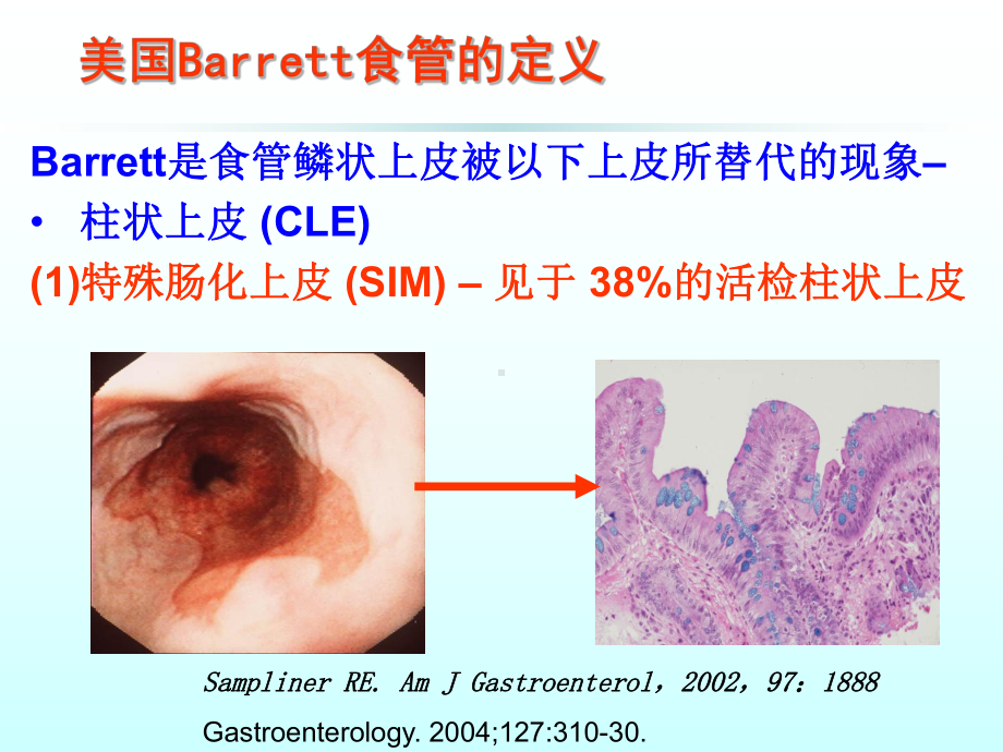 Barrett食管诊断与治疗课件.ppt_第2页