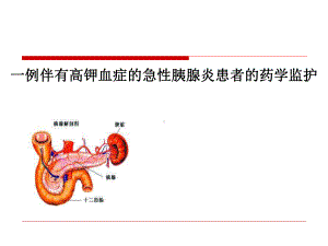 一例伴有高钾血症的急性胰腺炎患者的药学监护-胰腺炎-病例分析课件.ppt