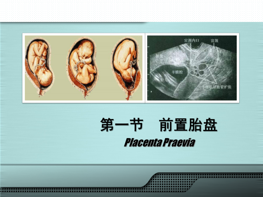 产科前置胎盘课件.ppt_第2页