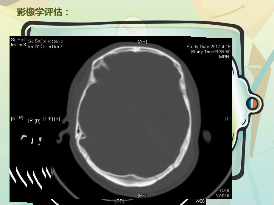 颅内压监测病例分享课件讲义.ppt_第3页