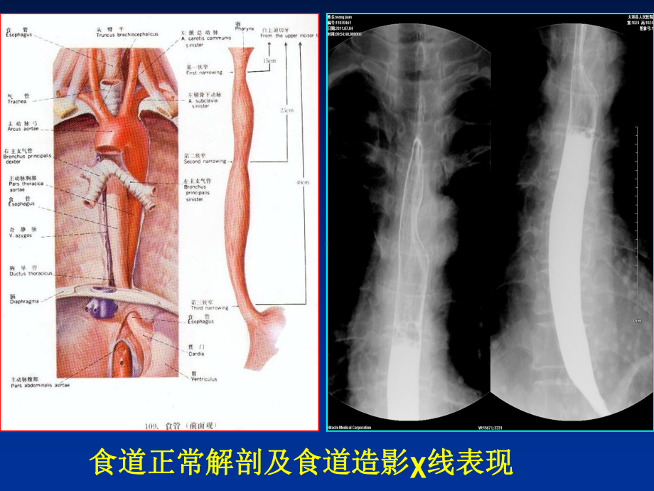 中晚期食道癌的X线诊断及内支架植入治疗[精]课件.ppt_第2页