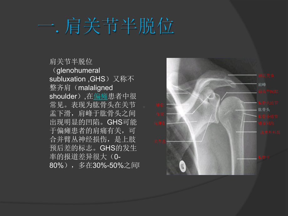 肩关节半脱位肩手综合征的康复治疗课件.pptx_第2页