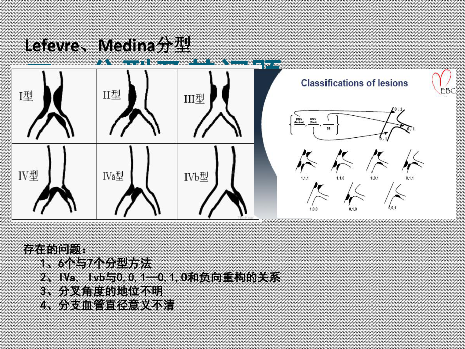 分叉病变分型和术式选择课件.ppt_第2页