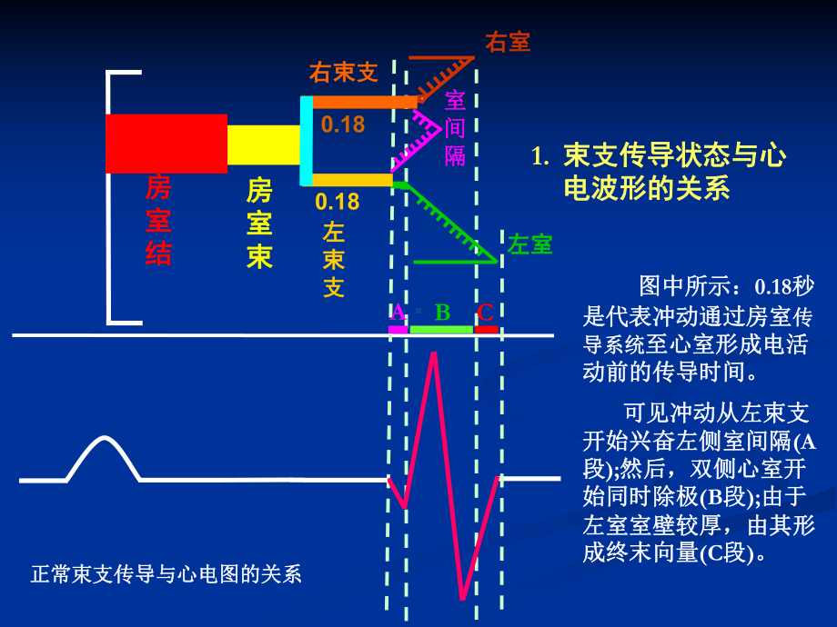 关于束支阻滞特殊心电现象的解析王永权课件.ppt_第3页