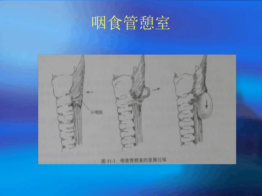 食道憩室手术护理课件.ppt_第3页