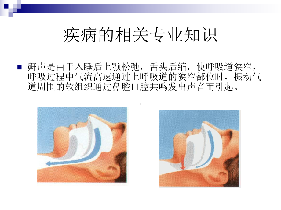 鼾症患者的护理查房 课件.ppt_第3页