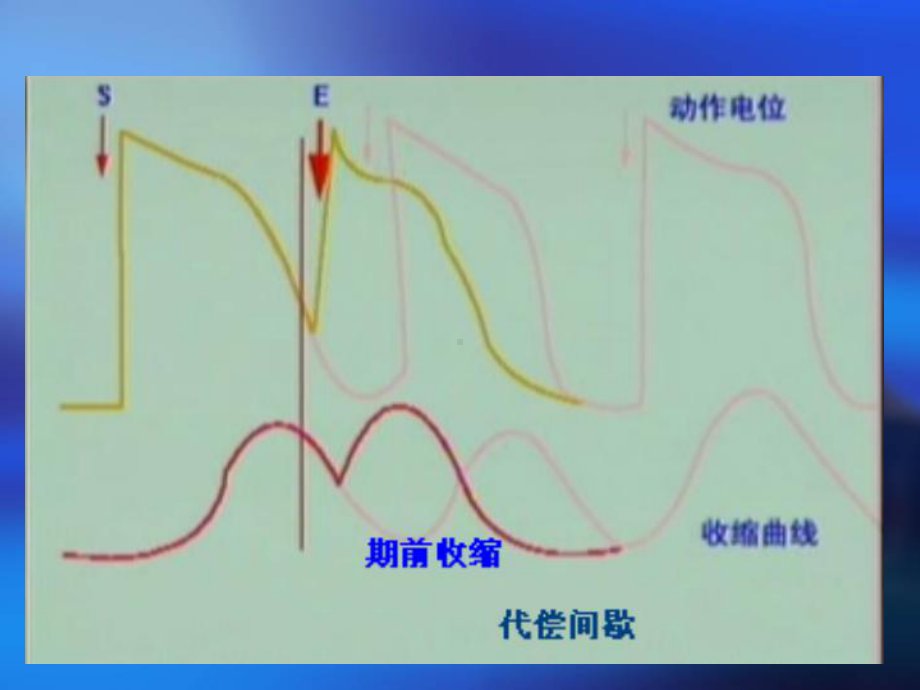 期前收缩与代偿间歇、蛙心灌流chen课件.ppt_第3页