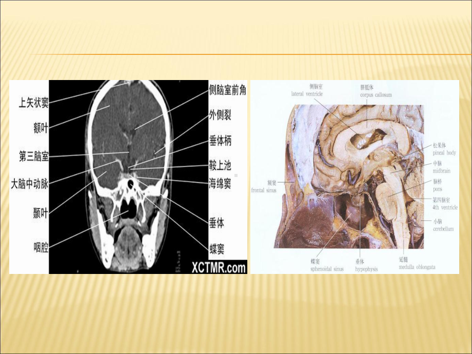 垂体瘤教学讲解课件.ppt_第3页