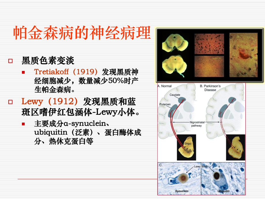 从发病过程重新帕金森病的诊断及治疗课件讲义.ppt_第3页