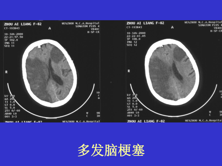 《常见疾病的CT片》课件.ppt_第2页