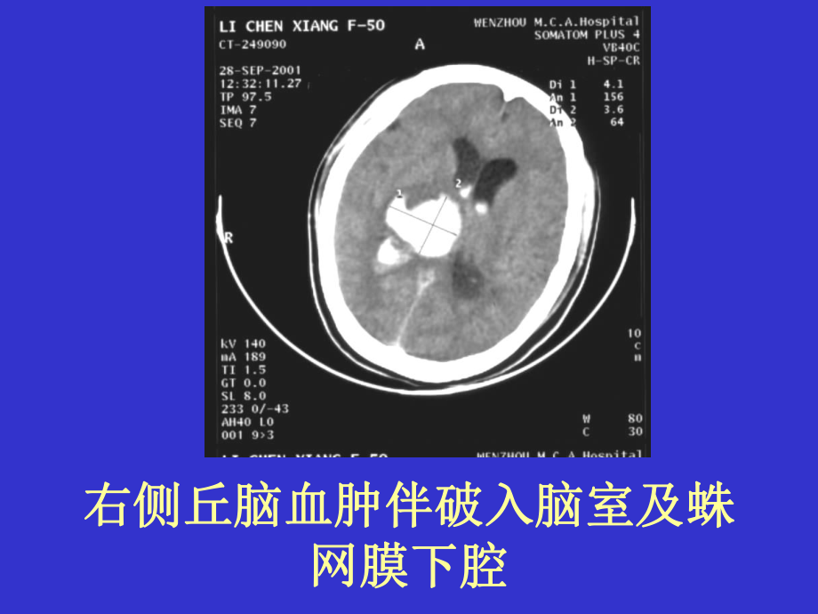 《常见疾病的CT片》课件.ppt_第3页