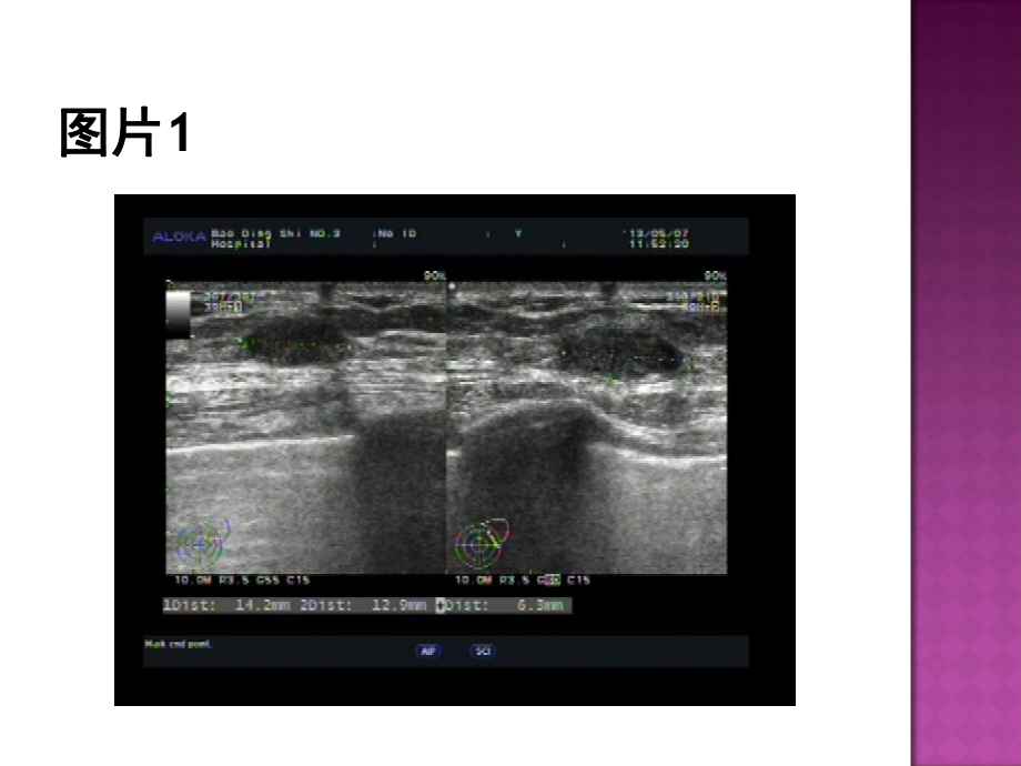 乳腺粘液腺癌一例原件课件.ppt_第3页