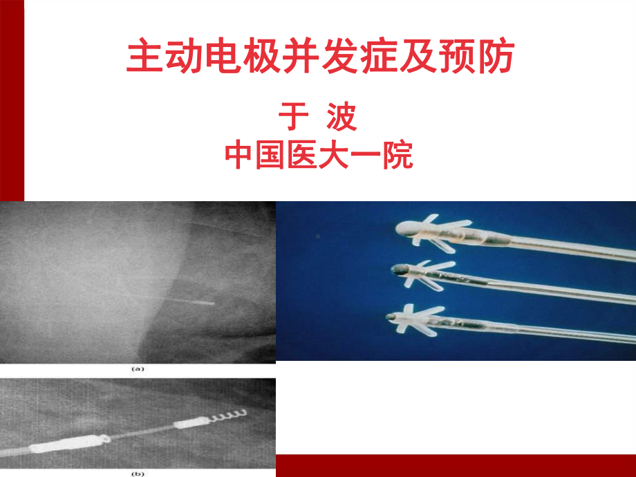 主动电极并发症及预防于波汇总课件.ppt_第1页