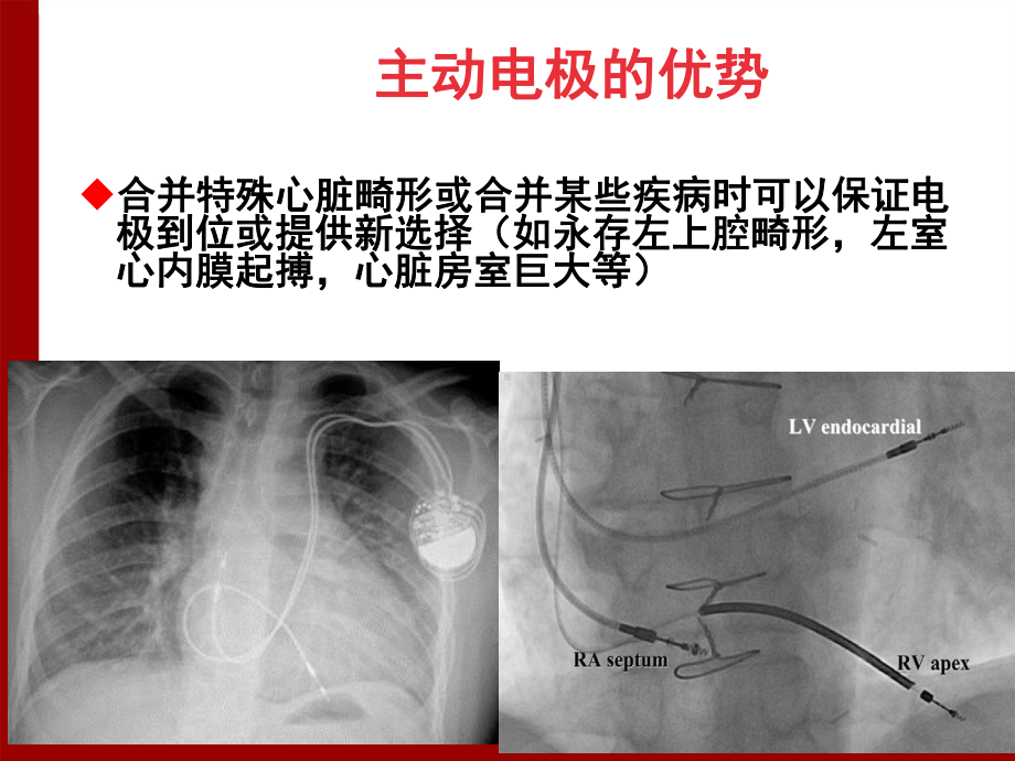 主动电极并发症及预防于波汇总课件.ppt_第3页